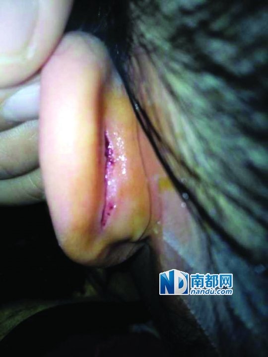 东莞6岁女童被幼师扯裂耳朵 血口长4厘米(图)