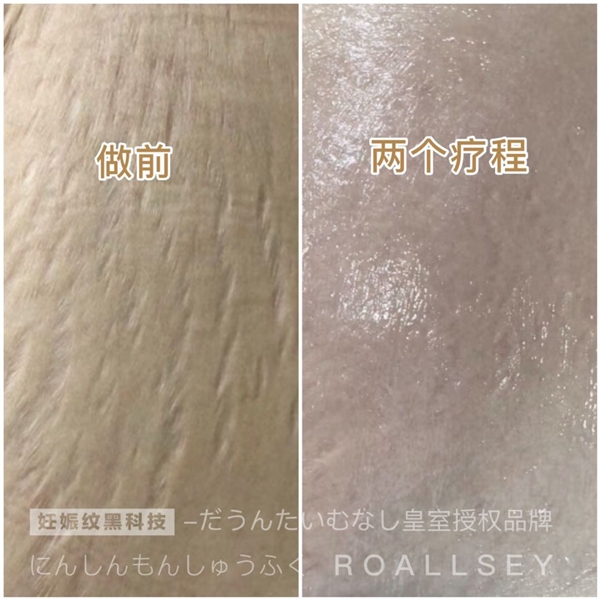 ROALLSEY妊娠纹修护皇室授权,1-2个月重归少女腹