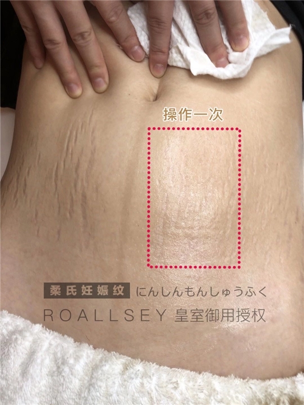 ROALLSEY妊娠纹修护皇室授权,1-2个月重归少女腹