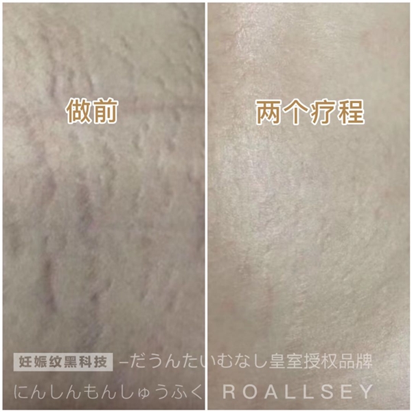 ROALLSEY妊娠纹修护皇室授权,1-2个月重归少女腹