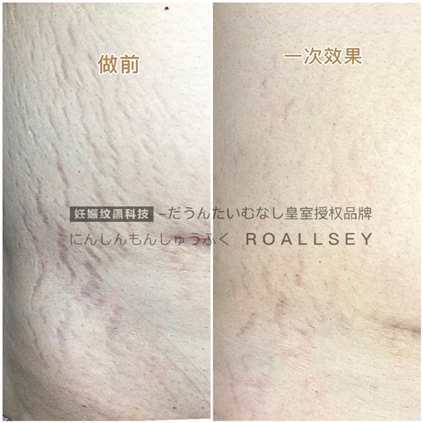 ROALLSEY妊娠纹修护皇室授权,1-2个月重归少女腹