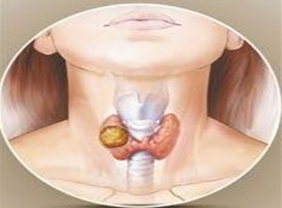 中医徐晓敏治疗甲状腺炎.png 1.png