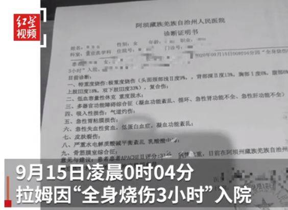 太惨烈！网红拉姆遭前夫纵火焚烧3小时 全身烧伤85%