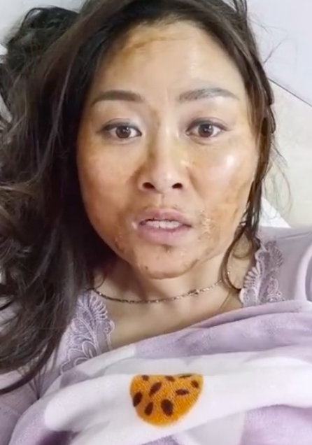 奥密毁容？女子感染新冠高烧后满脸发黑 