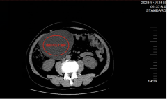 男子患肠系膜肿瘤肚