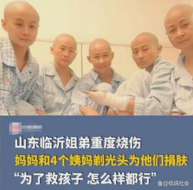 姐弟烧伤四位姨妈剃光头捐头皮：为了救孩子怎么样都行