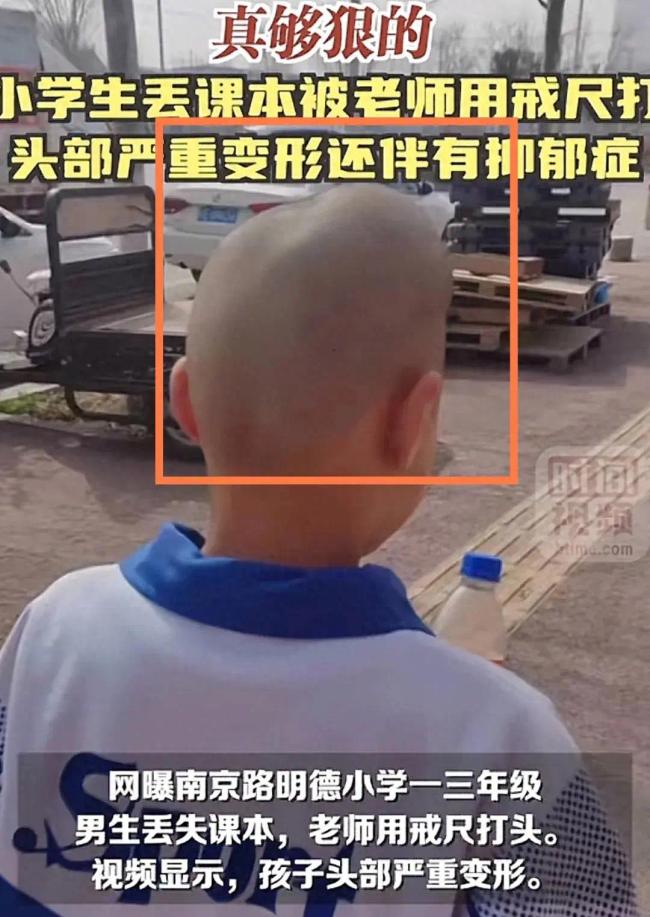 小学生被老师用戒尺打头致严重变形 只因不小心弄丢课本